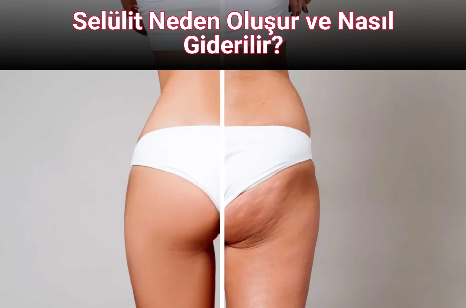 Selülit Neden Oluşur ve Nasıl Giderilir?
