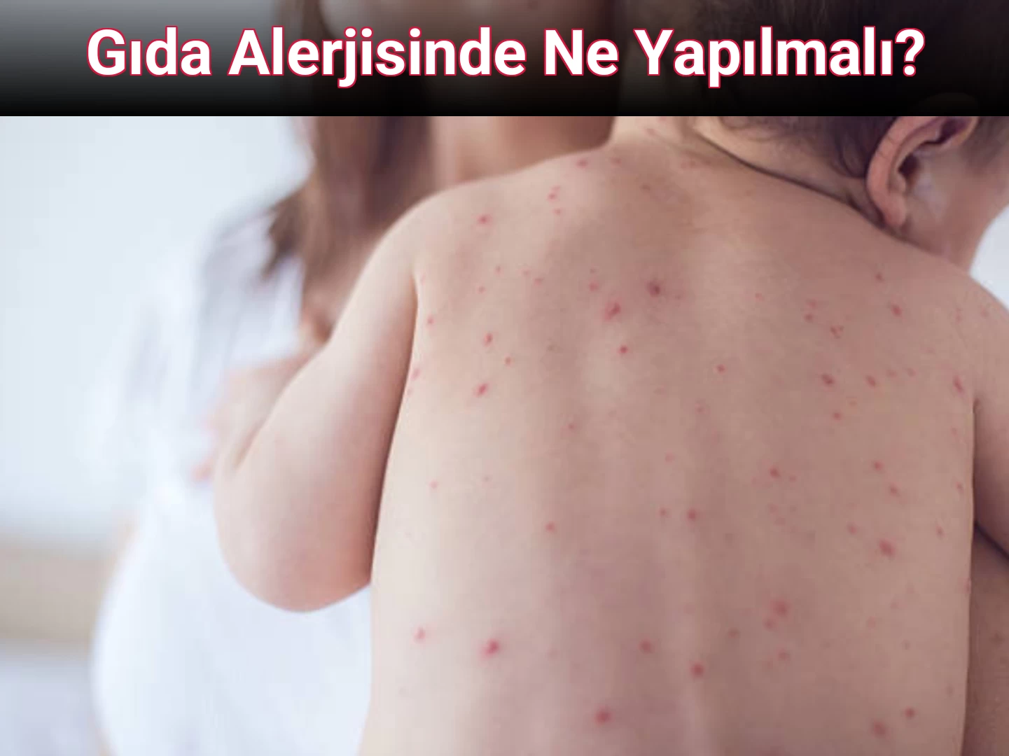 Gıda Alerjisinde Ne Yapılmalı?