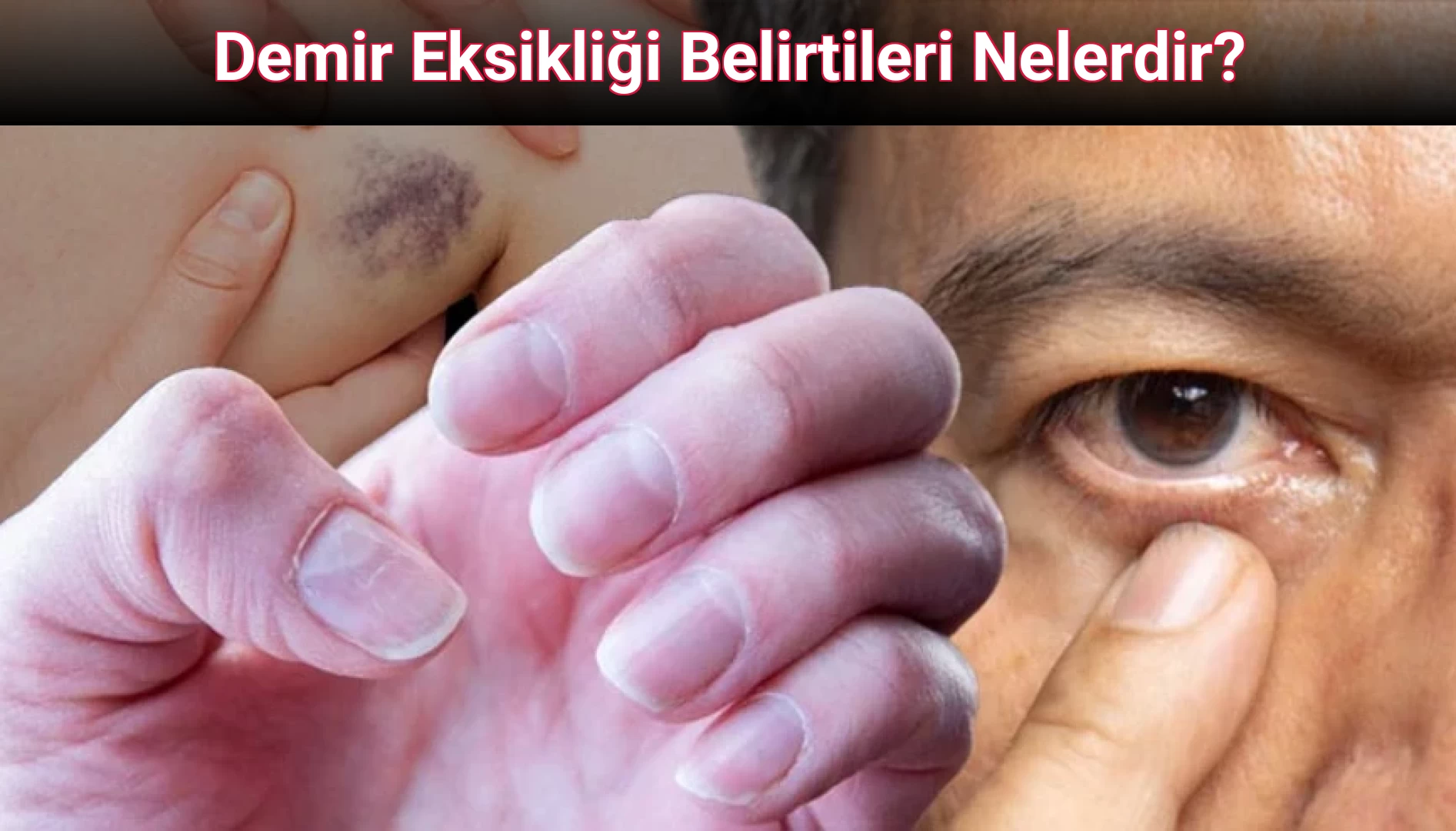 Demir Eksikliği Belirtileri Nelerdir?