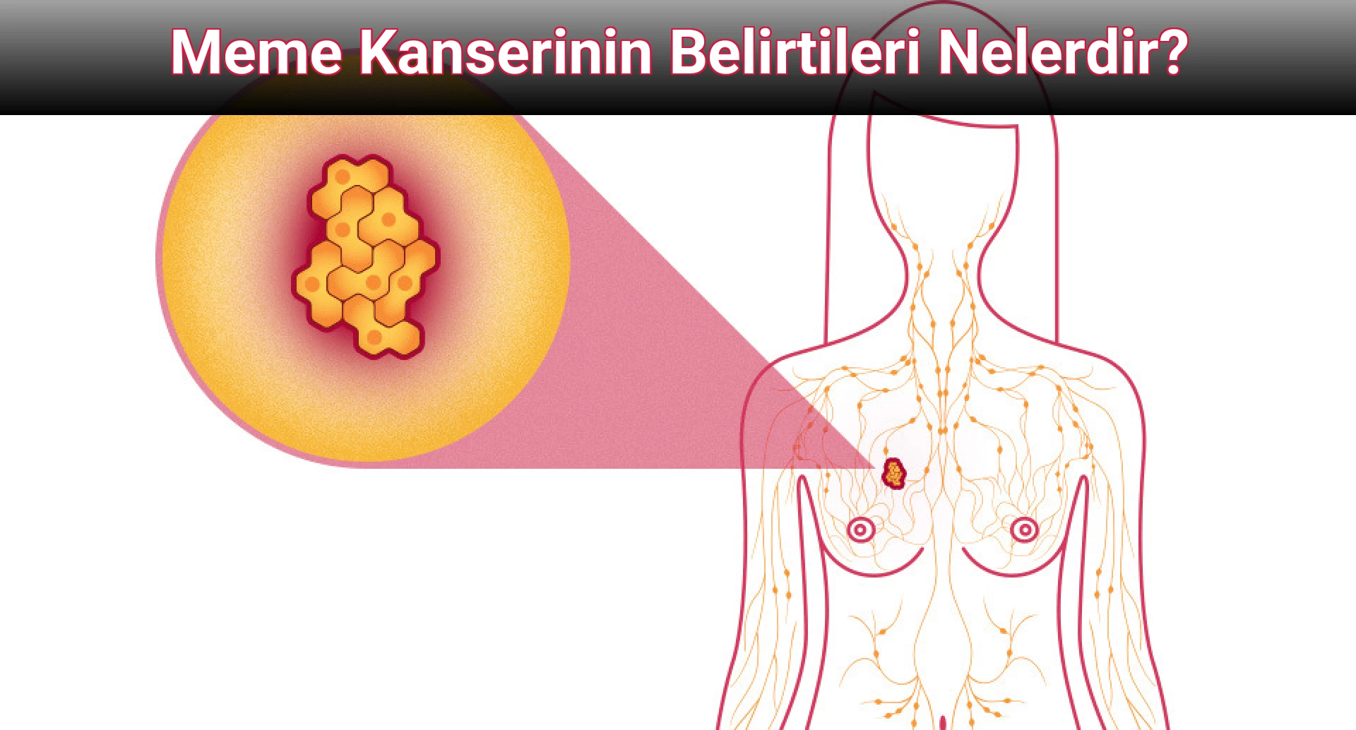 Meme Kanserinin Belirtileri Nelerdir?