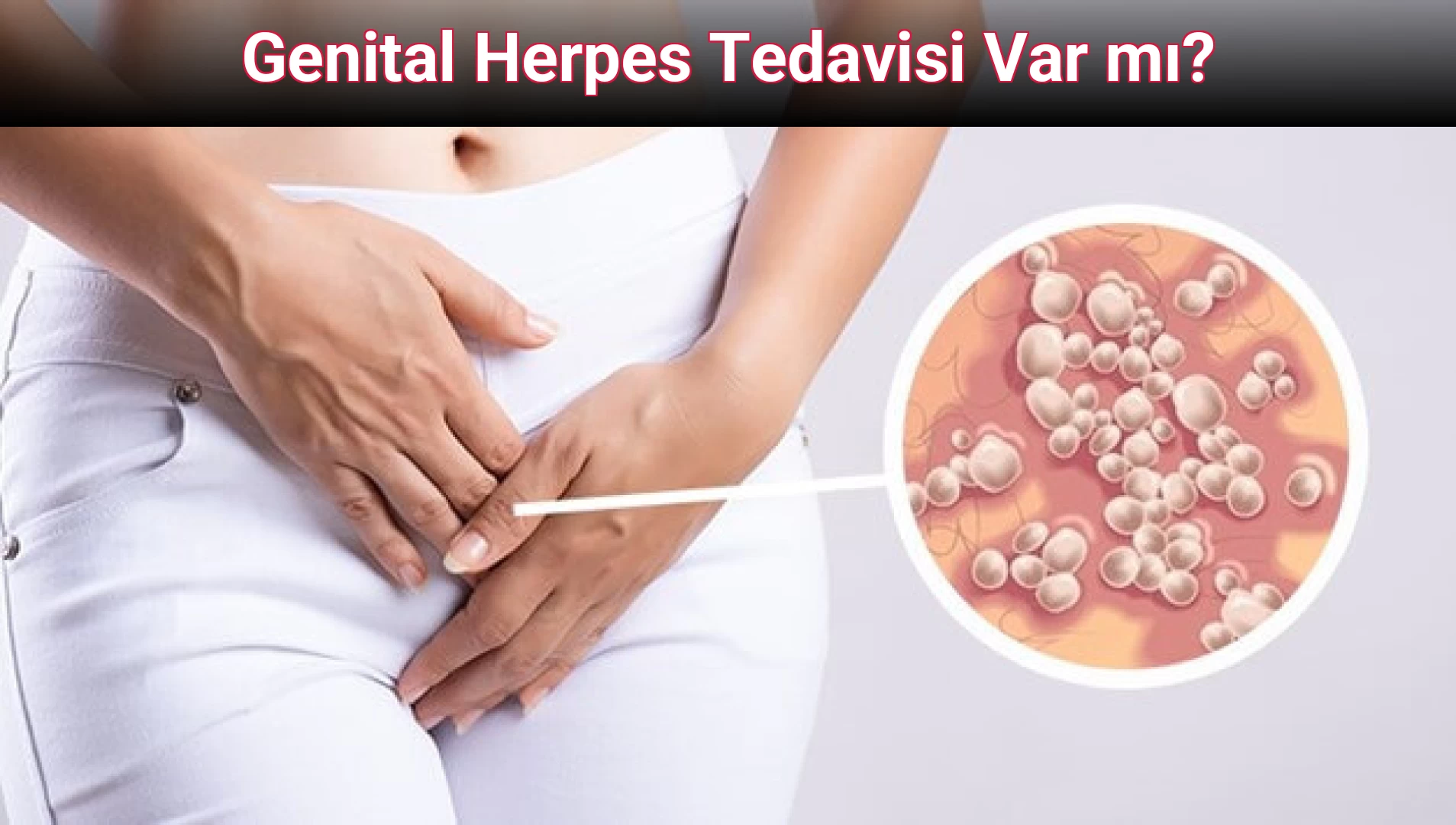 Genital Herpes Tedavisi Var mı?