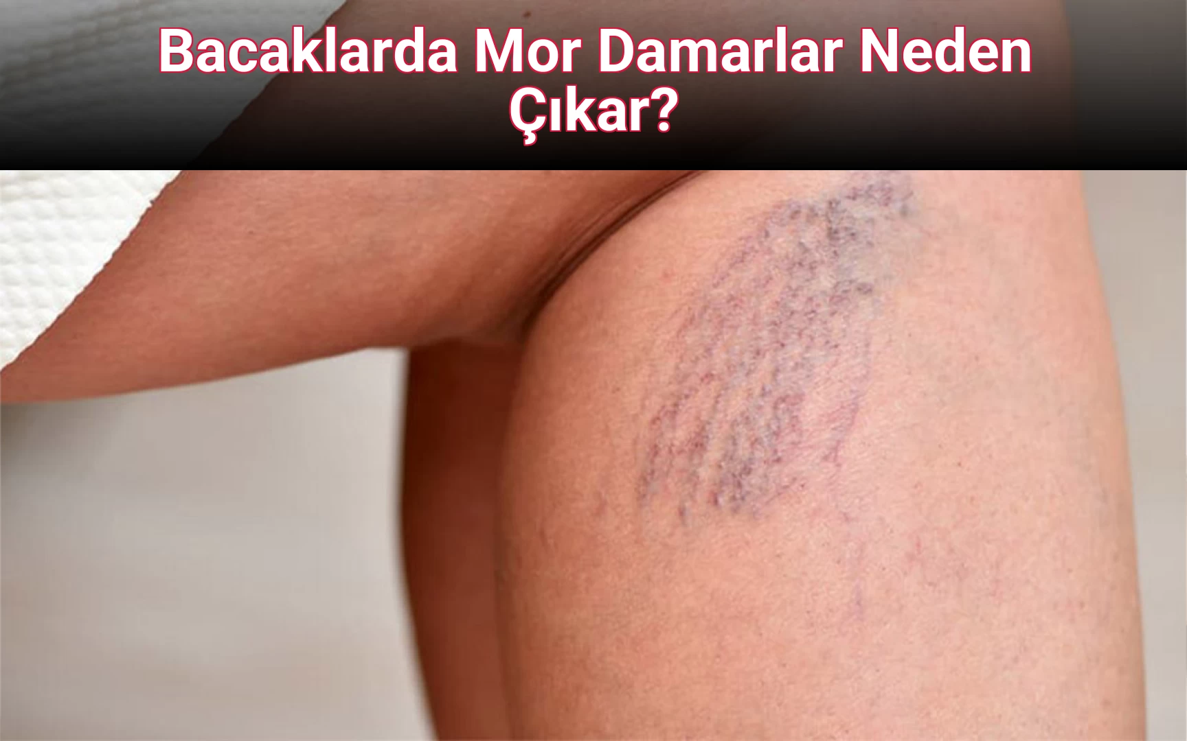 Bacaklarda Mor Damarlar Neden Çıkar?
