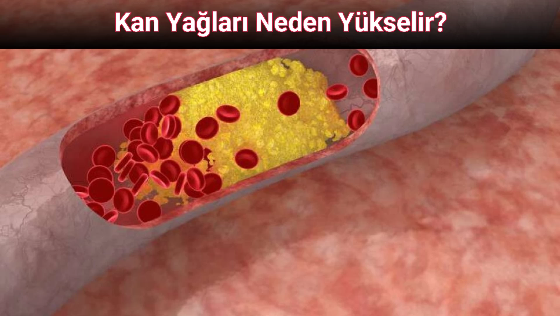 Kan Yağları Neden Yükselir?