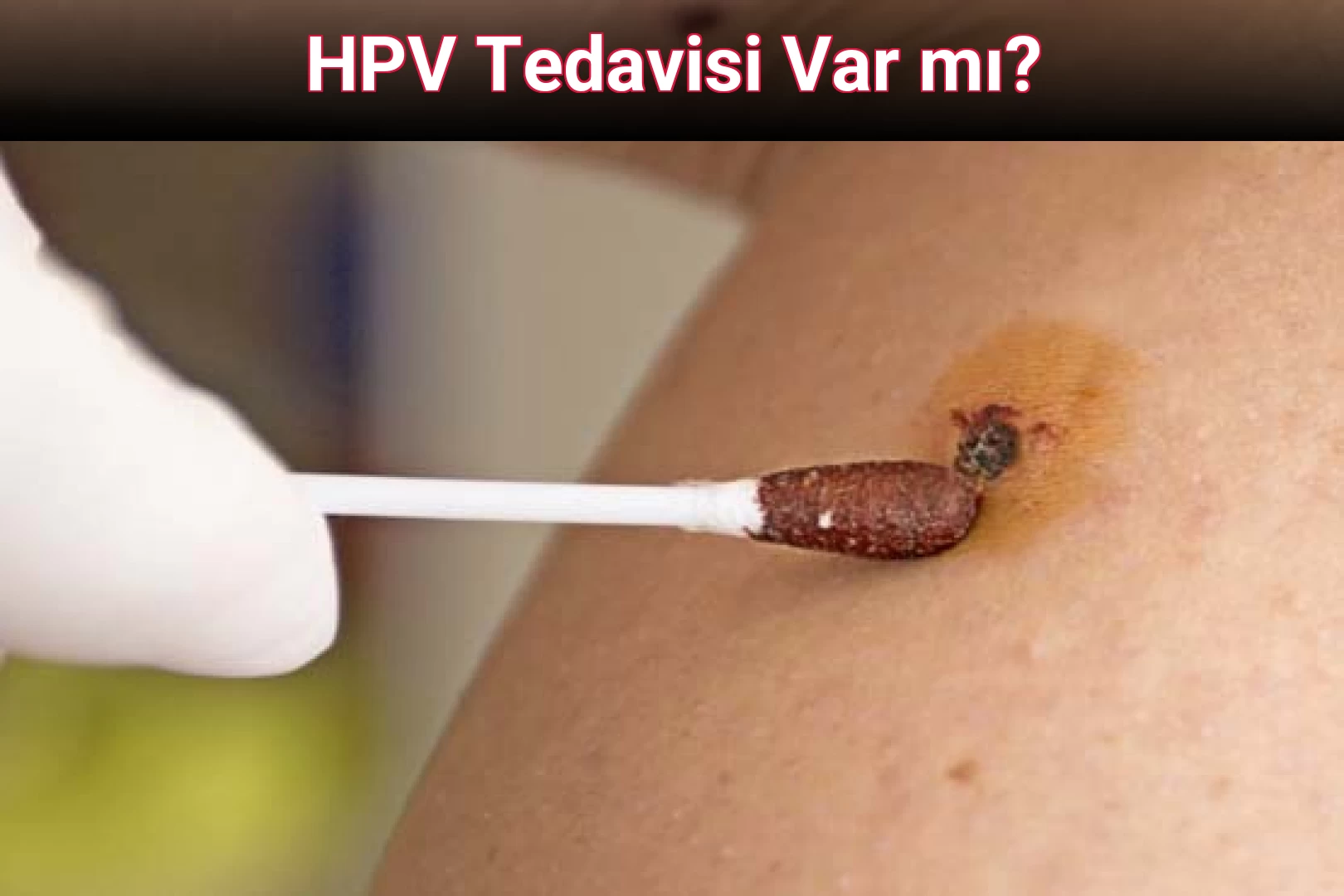 HPV Tedavisi Var mı?