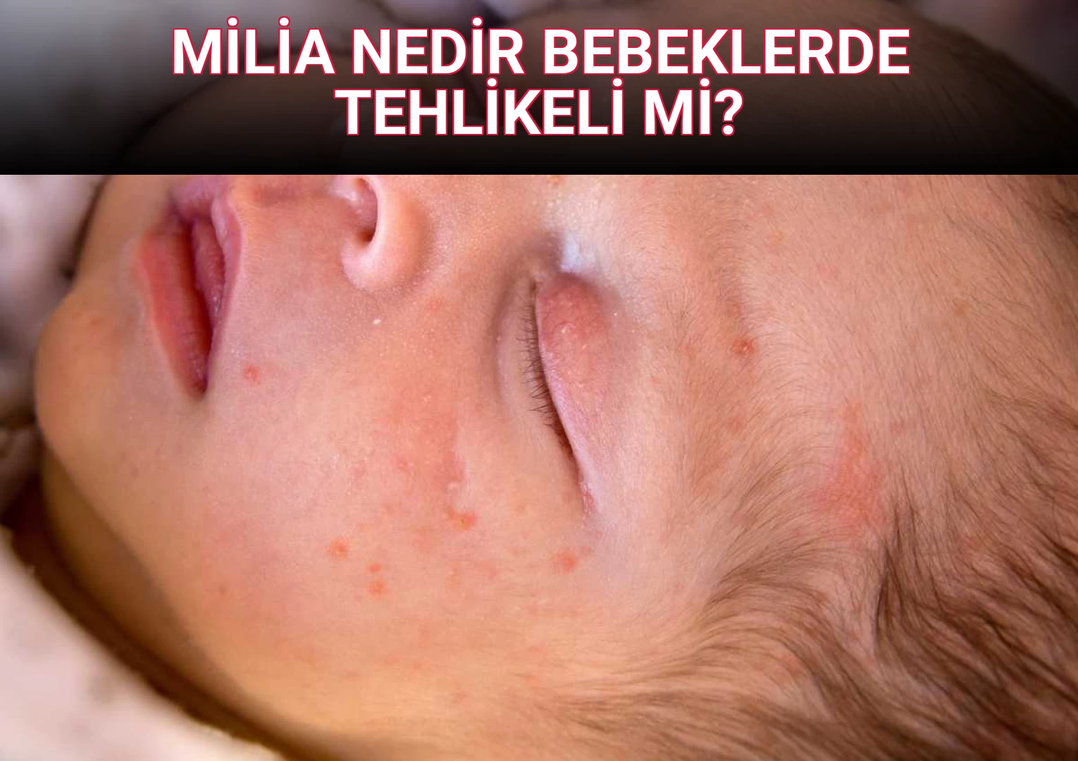 MİLİA NEDİR BEBEKLERDE TEHLİKELİ Mİ?