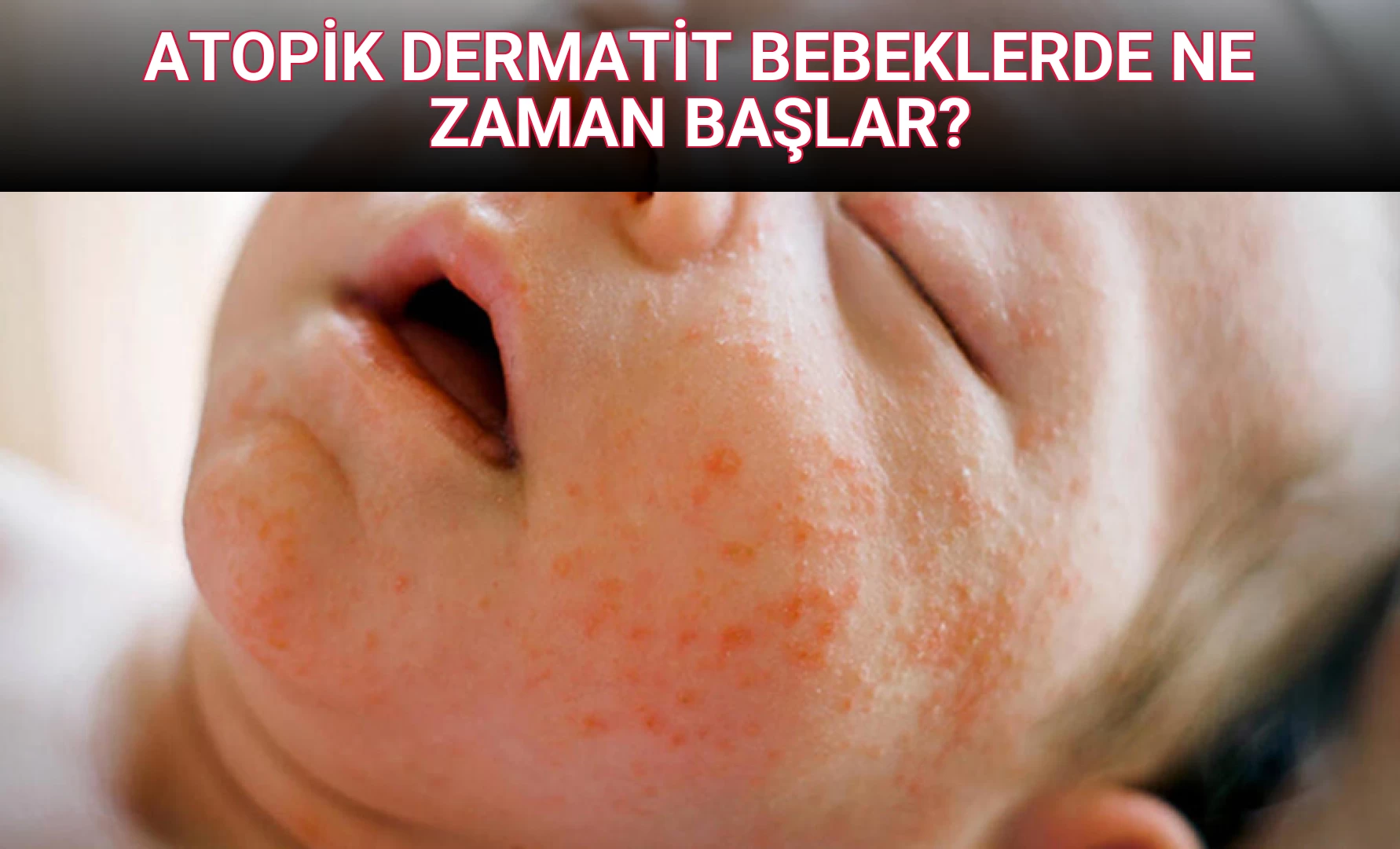 ATOPİK DERMATİT BEBEKLERDE NE ZAMAN BAŞLAR?