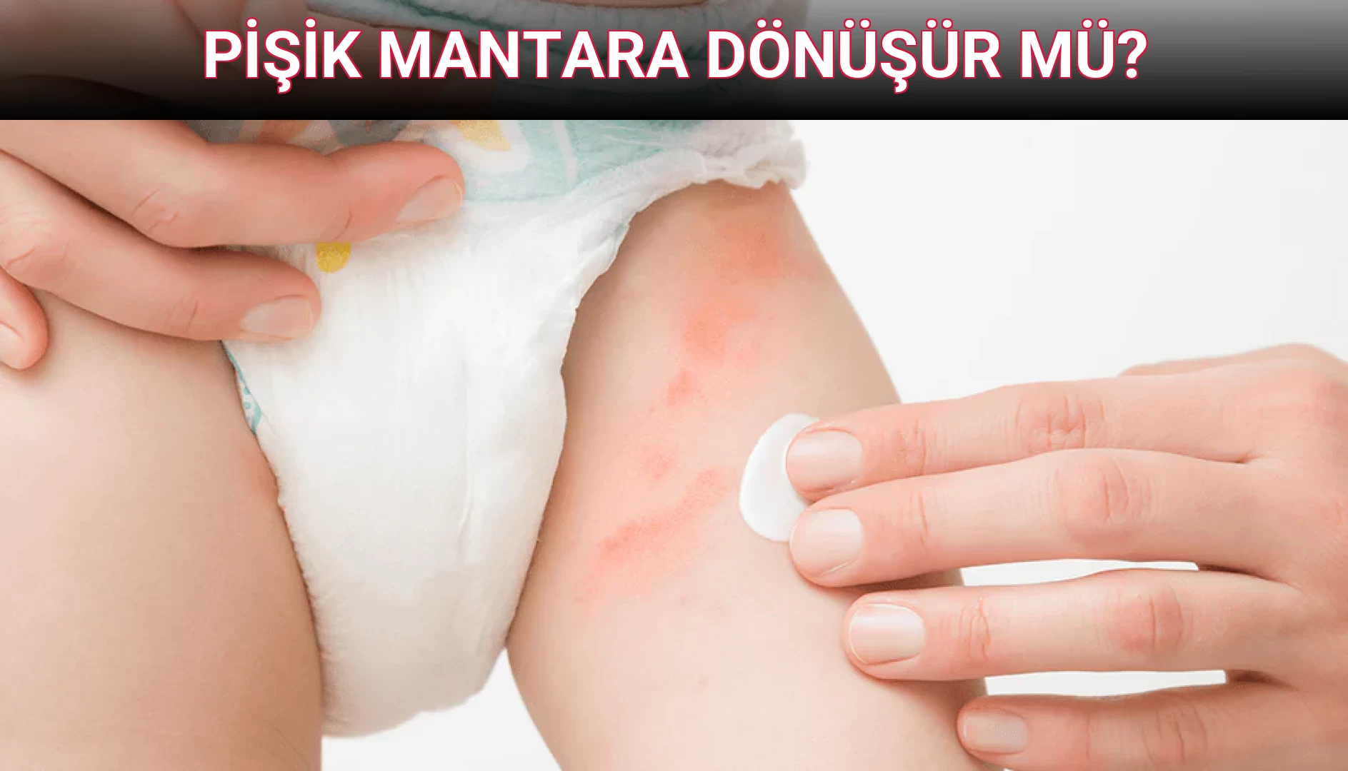PİŞİK MANTARA DÖNÜŞÜR MÜ?