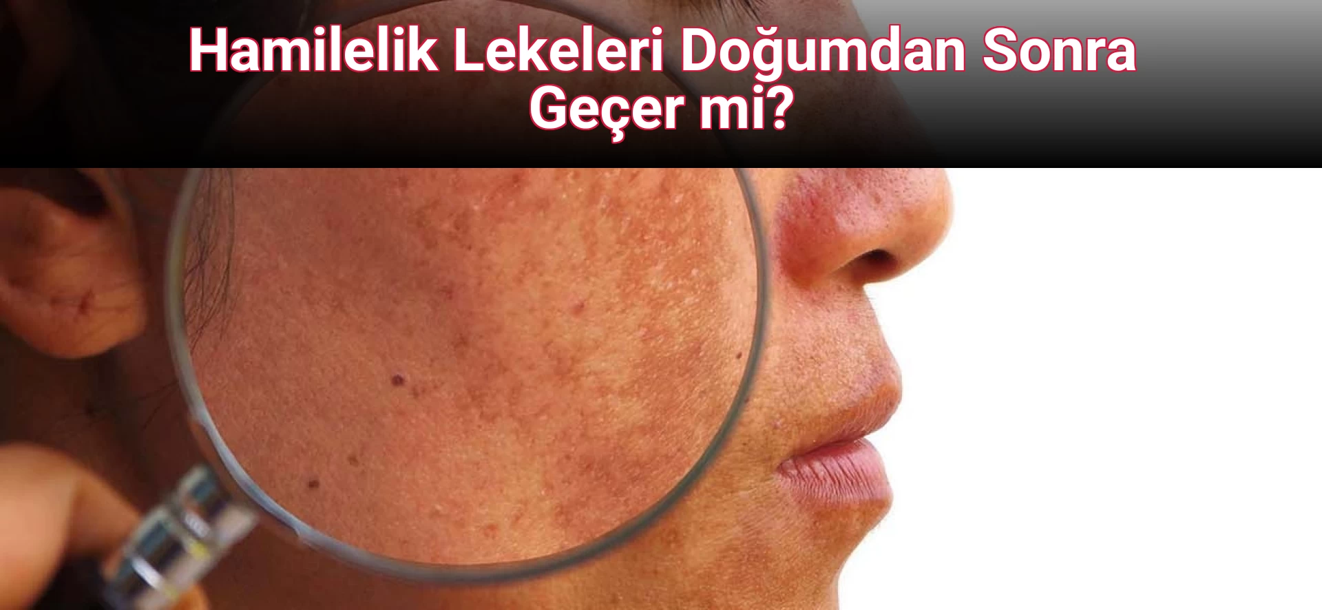 Hamilelik Lekeleri Doğumdan Sonra Geçer mi?